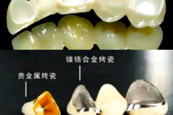 牙齿镶牙好还是种牙好一点呢(牙齿镶