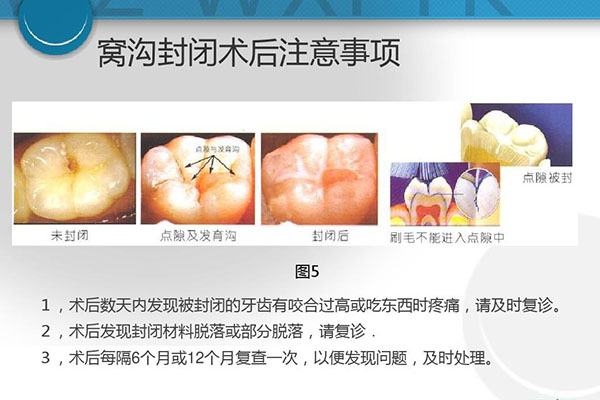 儿童六龄齿窝沟封闭(儿童六龄齿窝沟
