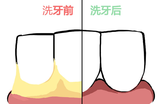 喝茶牙齿黄(喝茶牙齿黄了能恢复吗)