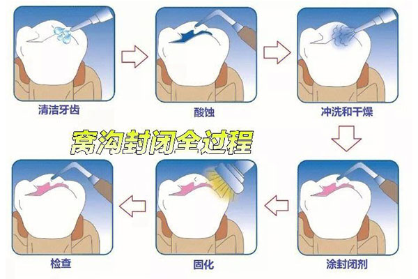 儿童六龄牙窝沟封闭到底好不好(儿童