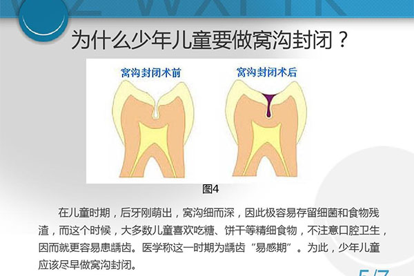 儿童几岁做窝沟封闭最好(儿童几岁做